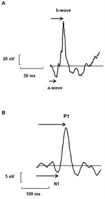 A Reflection Upon the Contribution of Retinal and Cortical Electrophysiology to Time of Information Processing in Psychiatric Disorders